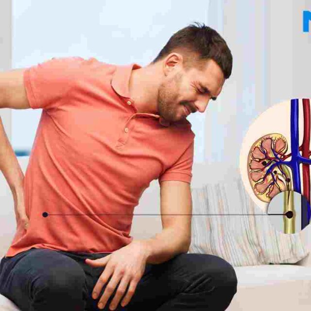 Kidney Stone – Causes, Symptoms, Treatment Options & More