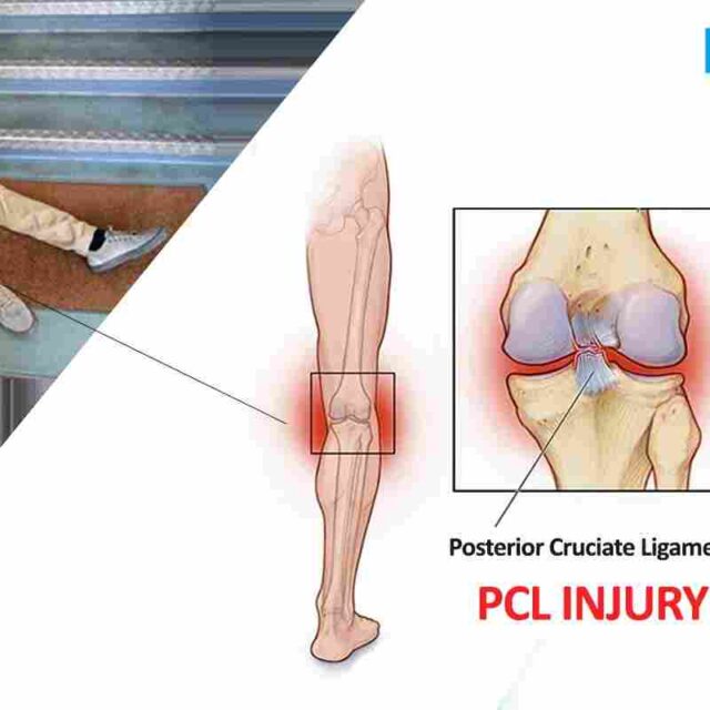Posterior Cruciate Ligament (PCL) Injury: Things You Need To Know About It