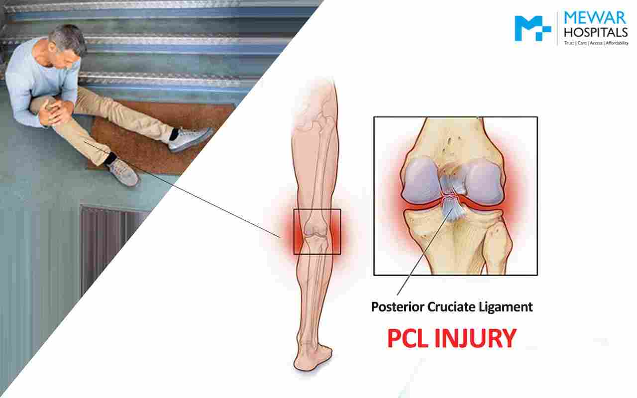 https://www.mewarhospitals.com/wp-content/uploads/2023/03/pcl-injury-causes-symptoms-and-treatments-compressed.jpg