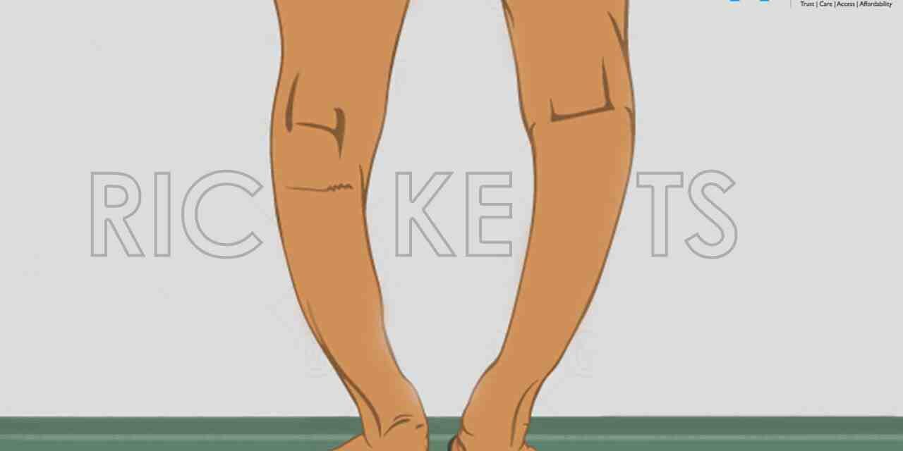 https://www.mewarhospitals.com/wp-content/uploads/2023/03/rickets-causes-symptoms-and-treatments-compressed-1280x640.jpg