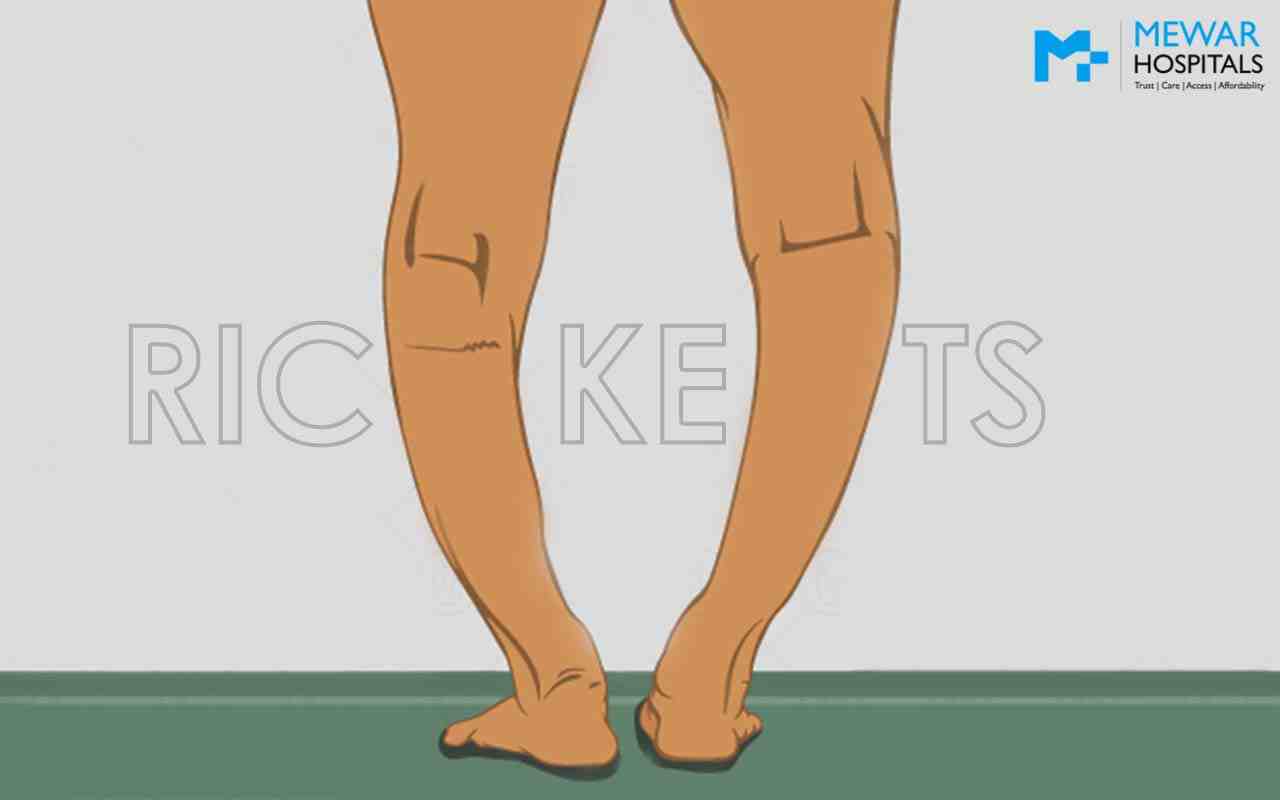 https://www.mewarhospitals.com/wp-content/uploads/2023/03/rickets-causes-symptoms-and-treatments-compressed.jpg
